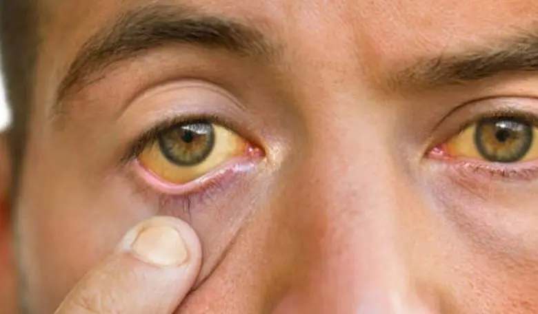  Difference Between Physiological and Pathological Jaundice 