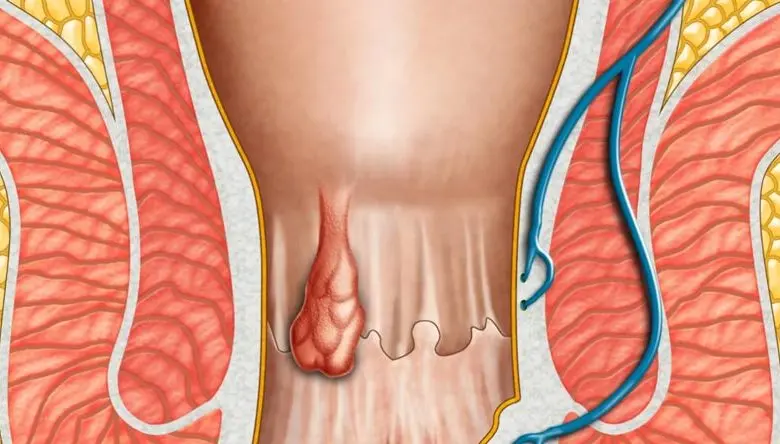  Difference Between Hernia and Hemorrhoid? 