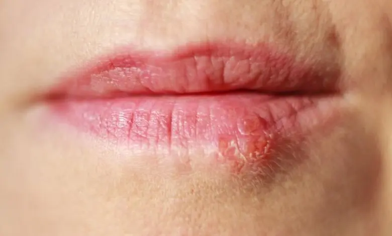  What Is the Difference Between Impetigo and Herpes? 