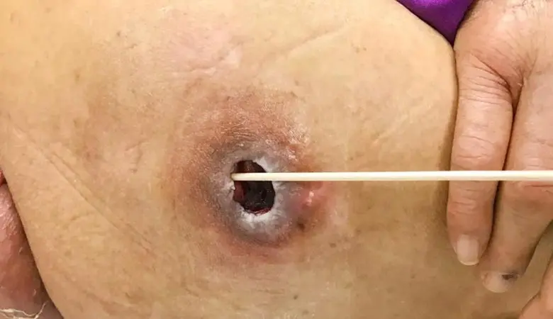  What Is the Difference Between Tunneling and Undermining? 